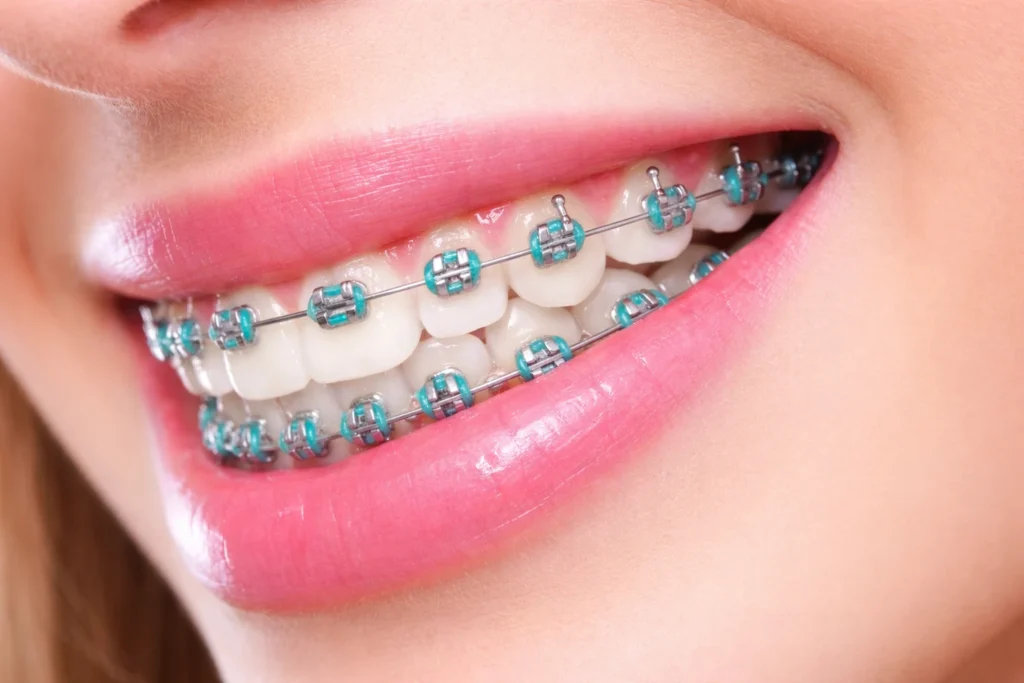 Braces Treatment​​ in Lucknow