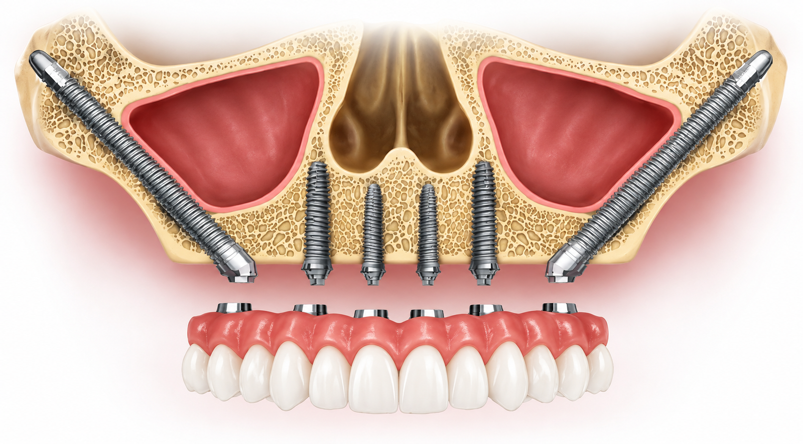 Zygoma Implants