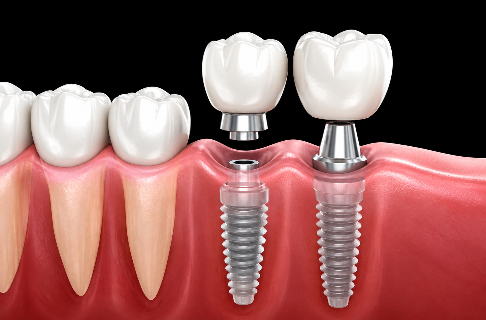 Dental Implants